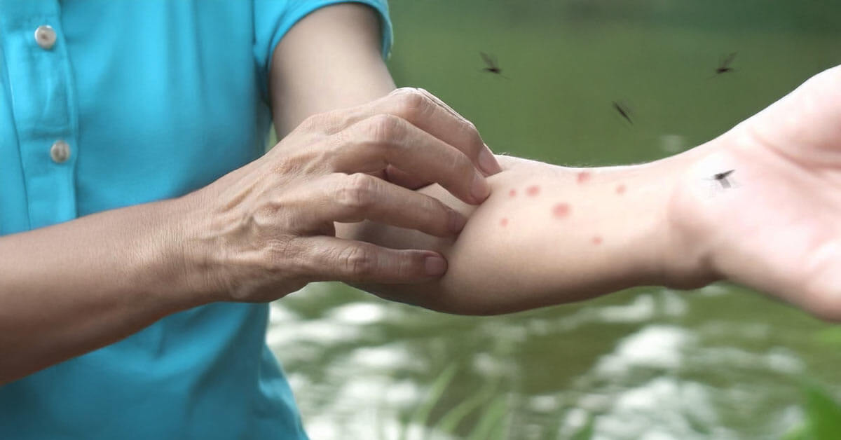 Person outdoors with visible mosquito bites on the arm while mosquitos fly nearby near a pond